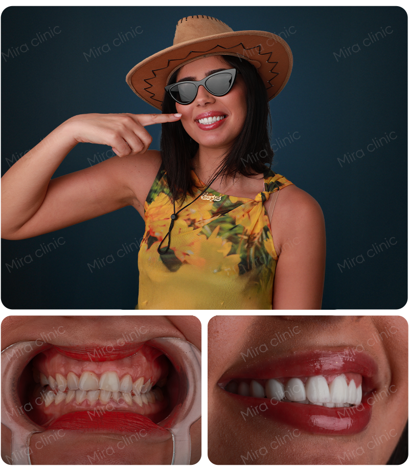 Hollywood smile before  after 